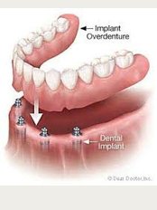 Aashvi Dental Care - Implant based denture