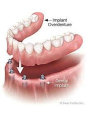 Aashvi Dental Care - Implant based denture 