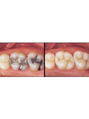 Amalgam Filling - Rishi Multispeciality Dental Clinic