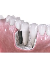 Bone Graft  - Rishi Multispeciality Dental Clinic