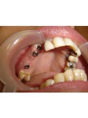 Implant Dentist Consultation - Rishi Multispeciality Dental Clinic