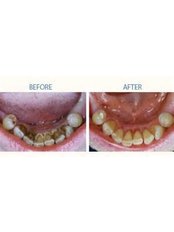 Teeth Cleaning - Salem Dentist - Top Dental Clinic Salem