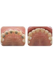 Lingual Braces - Salem Dentist - Top Dental Clinic Salem