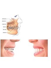 Accelerated Braces™ - Salem Dentist - Top Dental Clinic Salem
