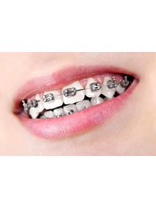 Braces - Salem Dentist - Top Dental Clinic Salem