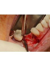 Wisdom Tooth Extraction - Salem Dentist - Top Dental Clinic Salem