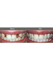 Dental Bridges - Salem Dentist - Top Dental Clinic Salem