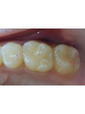 Dental Sealant - Dr.Parekh's Dental Care