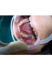 Dental Crowns - Dr.Parekh's Dental Care