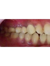 Dental Bridges - Dr.Parekh's Dental Care
