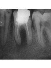Complex Root Canal - Dr.Parekh's Dental Care