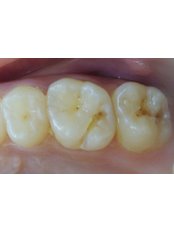 Dental Sealant - Dr.Parekh's Dental Care