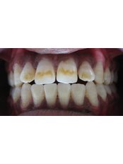 Teeth Whitening - Dr.Parekh's Dental Care