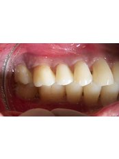 Gum Surgery - Dr.Parekh's Dental Care