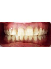 Fillings - Dr.Parekh's Dental Care