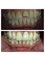 MAHATMA Multispeciality Dental Hospital and IMPLANT Centre - fractured tooth restored 