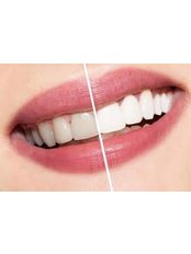 Laser Teeth Whitening - SPECIALITY DENTAL CARE CENTER