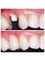 Muskan Dental Care and Implant center - ZIRCONIA IMPLANT 