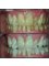 Dental Designs - Teeth whitening 