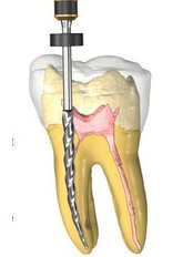 Root Canals - iSmile Orthodontic& Dental Care Clinic