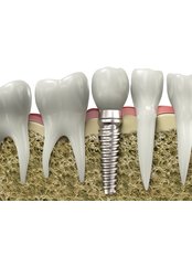 Dental Implants - iSmile Orthodontic& Dental Care Clinic