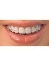 Braces - iSmile Orthodontic& Dental Care Clinic