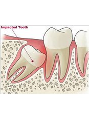 Wisdom Tooth Extraction - iSmile Orthodontic& Dental Care Clinic