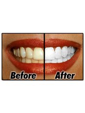 Teeth Whitening - iSmile Orthodontic& Dental Care Clinic
