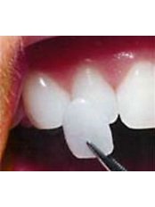 Veneers - iSmile Orthodontic& Dental Care Clinic