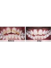 Chemical Teeth Whitening - Beyond Smiles Dental Clinic