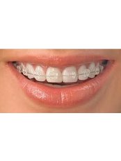 Ceramic Braces - Beyond Smiles Dental Clinic