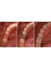 Dental Implants - Beyond Smiles Dental Clinic