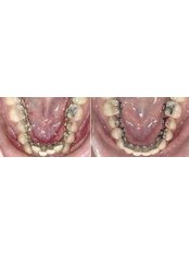 Lingual Braces - Beyond Smiles Dental Clinic