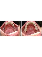 Dental Implants - Beyond Smiles Dental Clinic