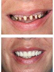 Dental Crowns - Dr Preay Mehta's Dental Spa