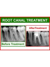 Molar Root Canal - Sanderi Multispeciality Dental Clinic