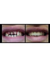 Dental Bridges - Sanderi Multispeciality Dental Clinic