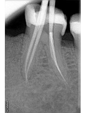 Root canals - Sanderi Multispeciality Dental Clinic