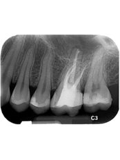 Molar Root Canal - Sanderi Multispeciality Dental Clinic