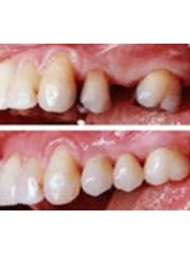 Porcelain Bridge - Sanderi Multispeciality Dental Clinic