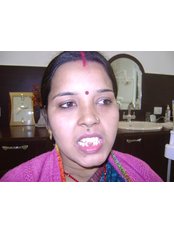 Dental Bridges - Rudra Dental