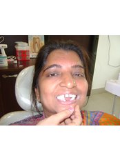 Porcelain Bridge - Rudra Dental