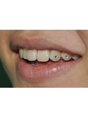 Tooth Jewellery - Rudra Dental