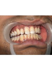 Teeth Whitening - Sanjeevani Dental Hospital