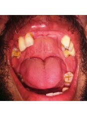 Dental Bridges - The Dental Zone
