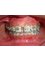 Whitestone Dental Clinic - midline spacing during treatment 
