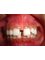 Whitestone Dental Clinic - midline spacing before treatment 