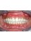 Whitestone Dental Clinic - closure of midline spacing 
