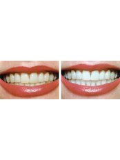 Teeth Whitening - Milda Dental Care Orthodontic Specialist
