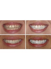 Teeth Whitening - Milda Dental Care Orthodontic Specialist